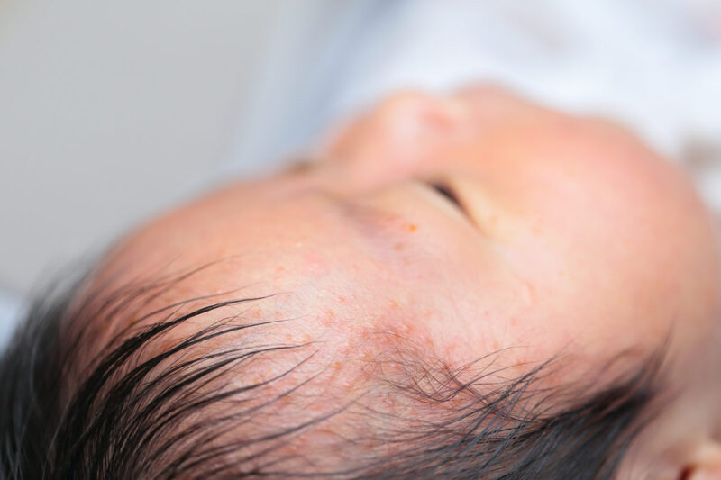 脂漏性皮膚炎について