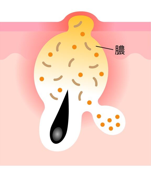 黄ニキビ