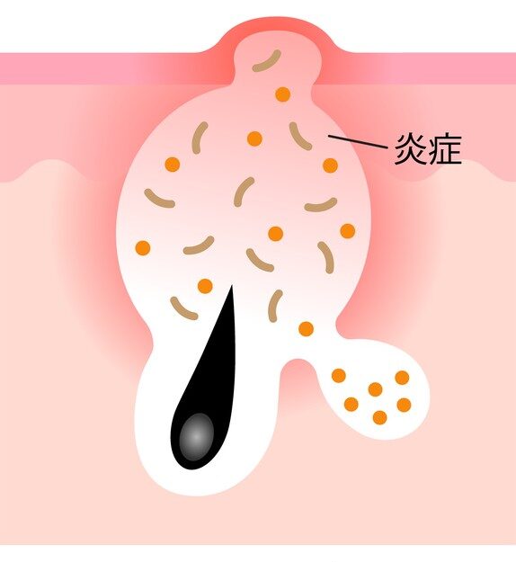赤ニキビ