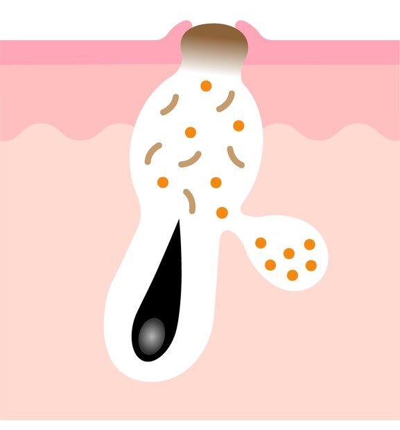 黒ニキビ